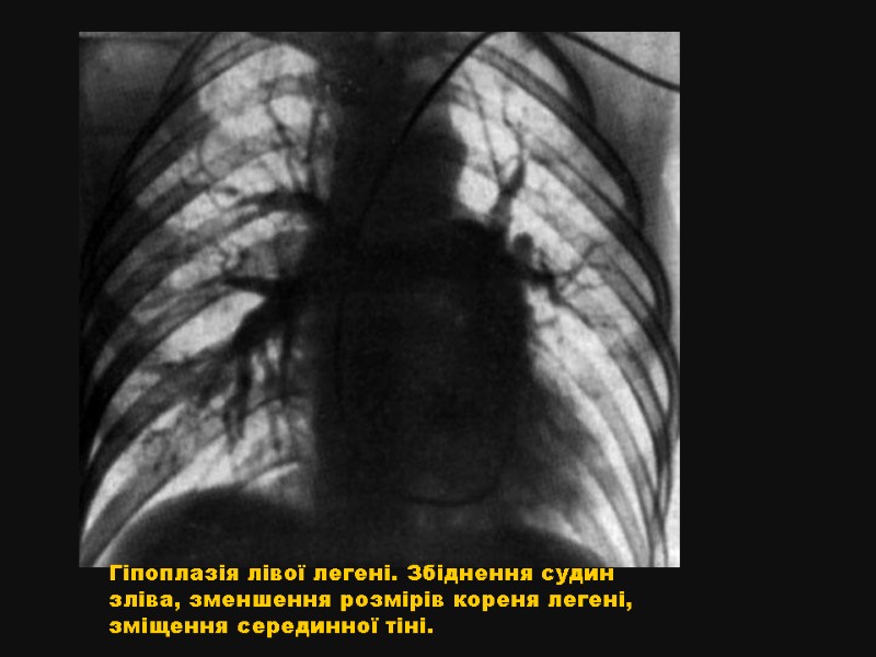 Гіпоплазія лівої легені. Збіднення судин зліва, зменшення розмірів кореня легені, зміщення серединної тіні.